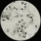 �����ټ�øȱ��ϸ����L-M TK